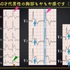 ECG-245：answer