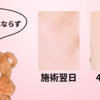 ピコレーザー３回目・濃くなった？カサブタにならず？【シミ取り記５✨】
