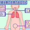 がんの放射線治療