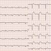 ECG-123：64才女性。定期受診の心電図で。。