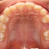歯の位置の入れ替わり