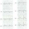 【心電図】