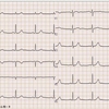 【コラム-021】正常心電図05＝(18誘導+1 &amp; Cabrera誘導)：43才女性。
