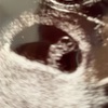 心拍確認👶🏻妊娠３ヶ月