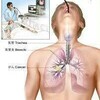 放射線技師が気管支鏡検査(Bronchoscopy)受けた感想・受けるコツなど書いてみる❗①