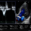 心エコー。連続の式で大動脈弁口面積を測ってみよう！。連続の式による弁口面積計測。