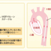 IABPについて