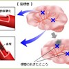 桂ざこばさんが脳梗塞で緊急入院されたそうで、容態が非常に心配されます。