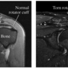 腱板断裂（rotator cuff tear)のMRI所見について