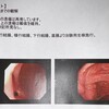 大腸内視鏡検査（治験中）グロ注意