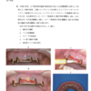 116回歯科医師国家試験【116C-30】義歯：バーアタッチメント編