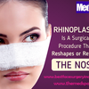 Rhinoplasty surgery–What happens during the surgery?