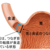 バレット食道とは？体験記その3