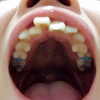 治療1　奥歯に青ゴム