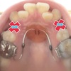 大人の歯列矯正 ⑩ 〜 抜歯、矯正装置装着、痛みについて※閲覧注意※ 〜