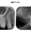 右上７の意図的再植を行ったケース②