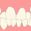 歯科矯正の記録日記始めます