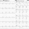 ECG-100：75才男性。クリスマスの胸痛発作です。