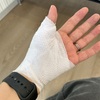  【ばね指手術体験】傷跡がほとんど分からない！縫わないばね指手術3週間後のリアルな経過