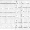 ECG-141：84才男性。の心電図の解釈を