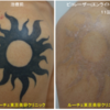 肩のベッタリと濃いタトゥーを薄くしています。