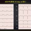 ECG-278：70才代男性。胸部不快発作でERへ。