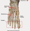 What Is Mortons Neuroma