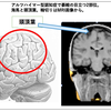 認知症でトイレを失敗する理由