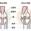 膝蓋骨脱臼