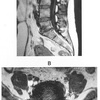 51回PT　午前問題9　44歳の女性。1か月前から腰痛および左下肢痛を訴える。腰椎MRIの矢状断像と水平断像とを下に示す。なお、水平断像は矢状断像で最も所見がある椎体間の高位のものである。 この患者にみられる所見はどれか。