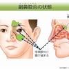 副鼻腔炎の恐ろしさを知り、鼻うがいの素晴らしさを知る。