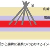 骨髄バンク・ドナーの提供方法は骨髄採取だけではありません。献血みたいに腕から血を採る方法もあります。