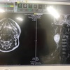 頚部神経鞘腫 治療記録⑦ 摘出手術 入院1日目