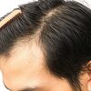 Fut Hair Transplant In Ahmedabad: A Quick Synopsis