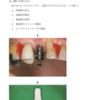 117回歯科医師国家試験【117A-30】インプラント学：オープントレー印象手順