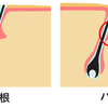 めんどくさがりのADHDにおすすめ　髭脱毛 最新の技術なら痛くない！