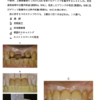 118回歯科医師国家試験【118B-60】歯冠補綴学：ジルコニアブリッジ製作手順