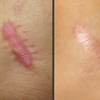 Cara Menghilangkan keloid