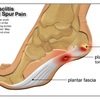 Heel Pain And Discomfort