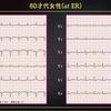 ECG263：80才代女性。Low Voltageを悩みました(-_-;*)。