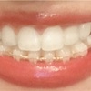 【部分矯正】４か月目にして上の歯のブラケットオフ【歯列矯正】