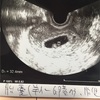 妊娠6週〜9週（6w〜9w）胎児の成長　つわりの変化