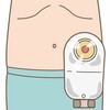 衝撃！人工肛門が胃に？東海大病院の驚愕医療ミスの真相