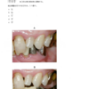 116回歯科医師国家試験【116A-25】歯冠補綴学：咬合調整どこする編