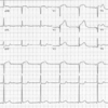 症例18：左胸痛と息切れを訴える40歳男性（Ann Emerg Med. 2020 Nov;76(5):590-592.）