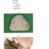 116回歯科医師国家試験【116D-44】歯冠補綴学：インプラントの印象編