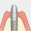 インプラント治療って何だろう？
