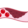 【血管】動脈硬化～血管の病気です～