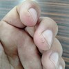 農作業のえいきょうで指の皮膚割れなどいっだ