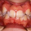装置と歯並び